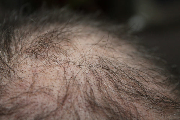 ¿Qué es la alopecia y cómo identificarla desde casa?